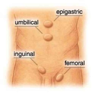 diagram of hernia locations on the body