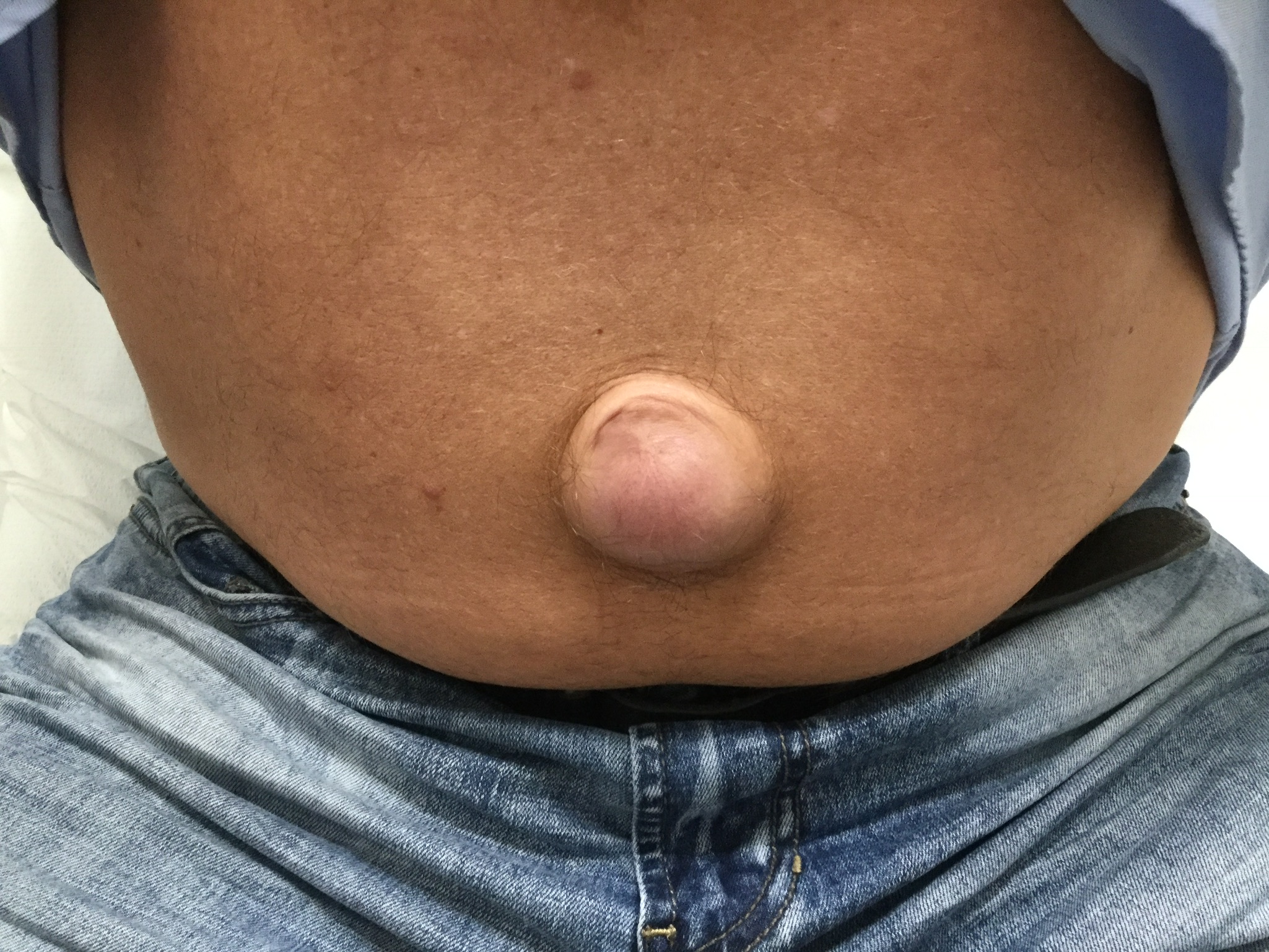 large umbilical hernia