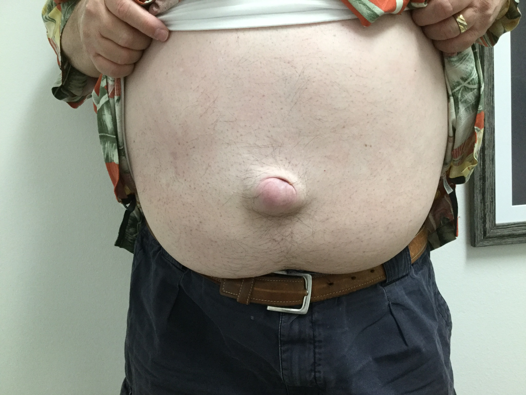 photo of umbilical hernia