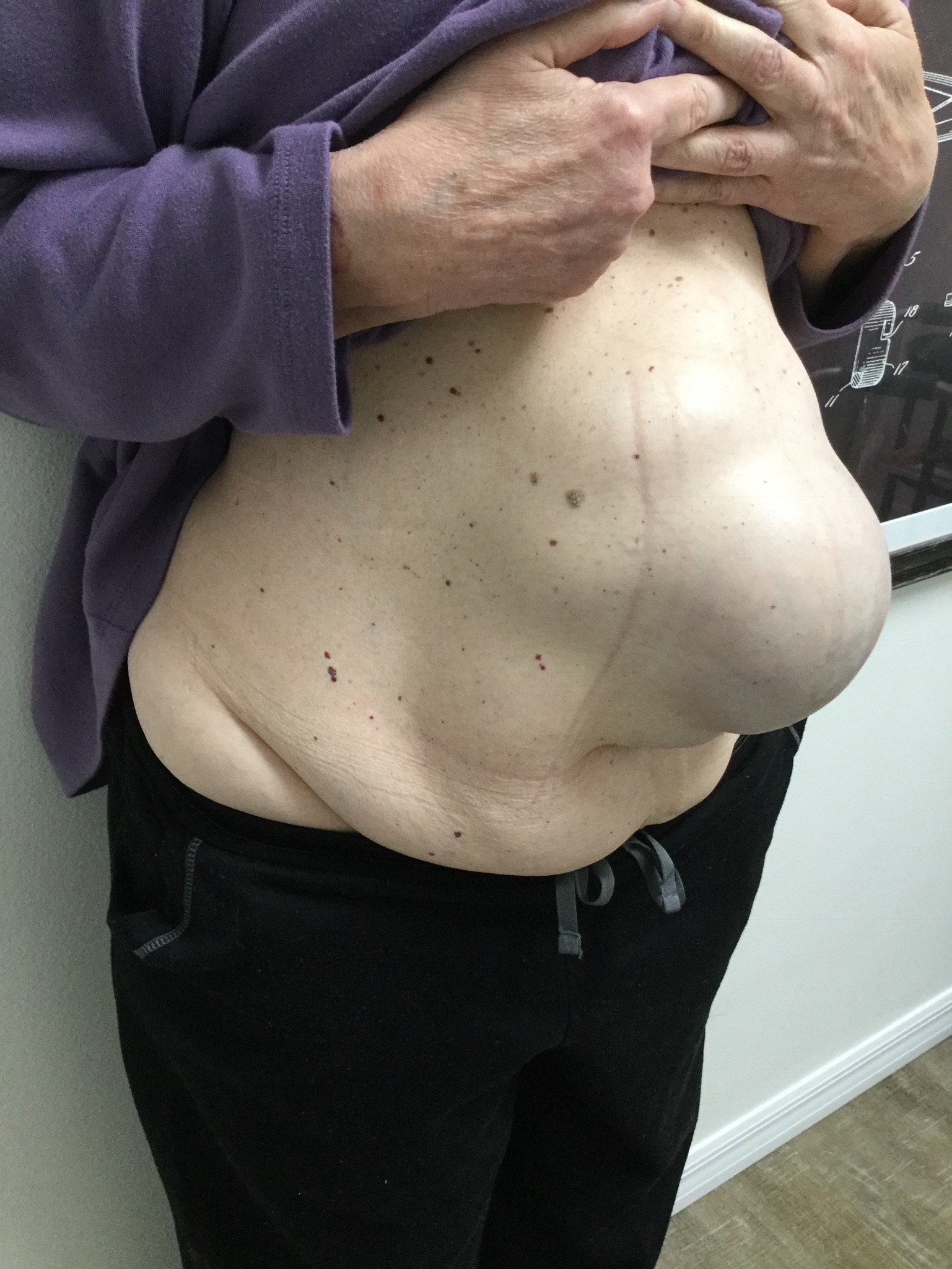 side image of Ventral Hernia