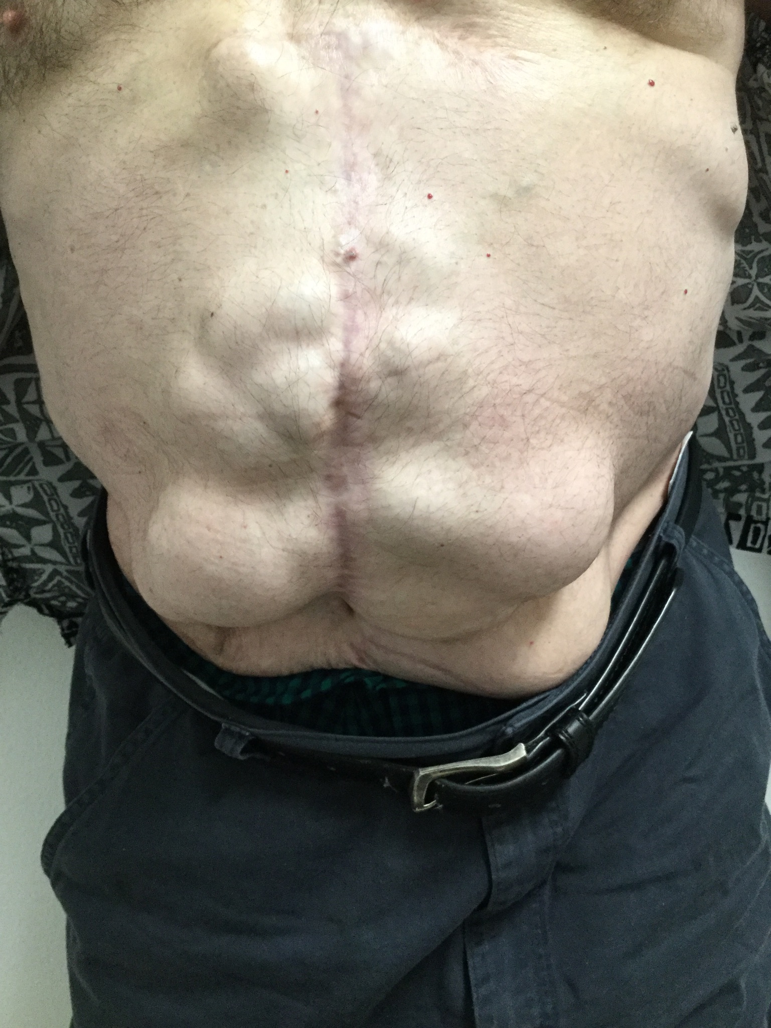 front image of Ventral Hernia