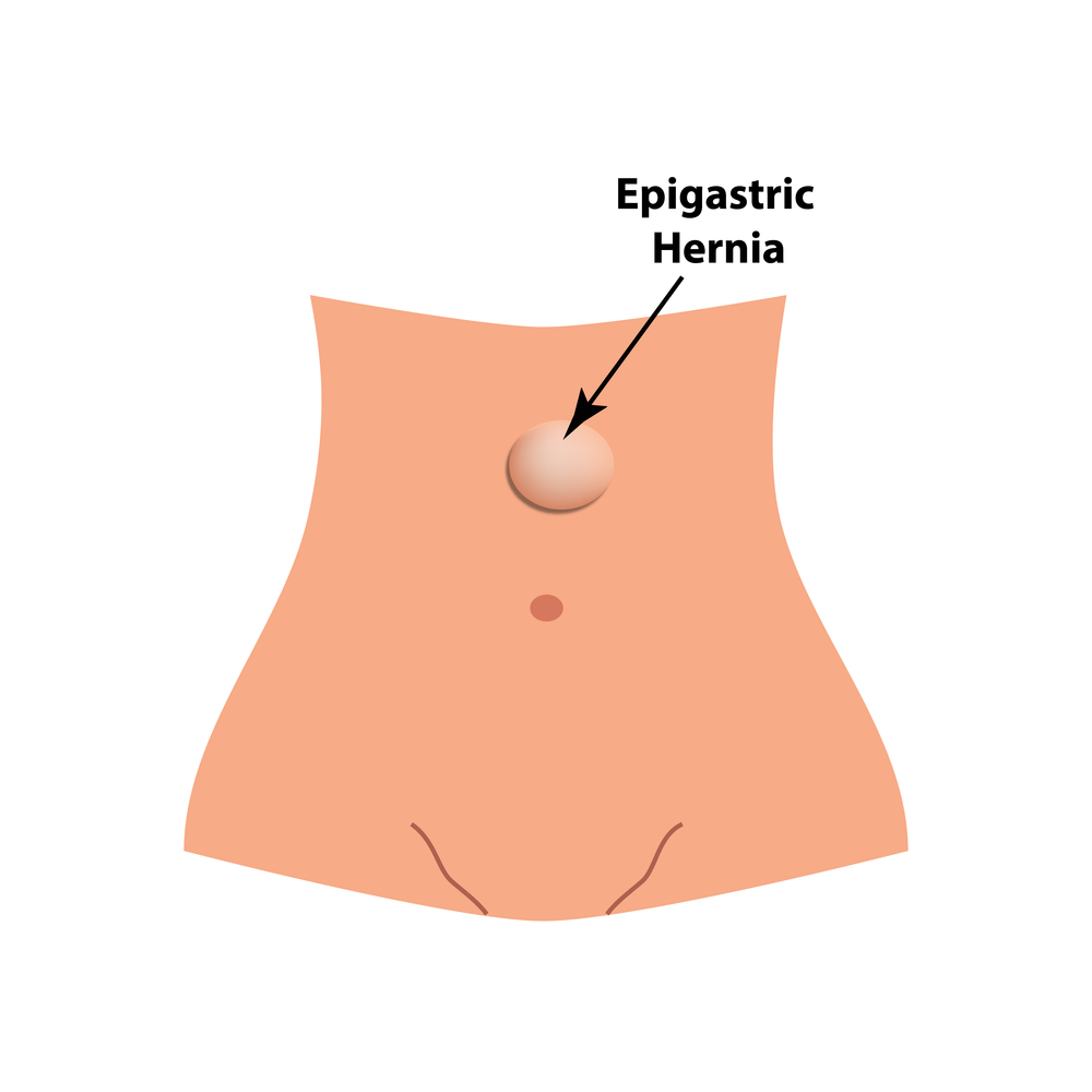 image of epigastric hernia